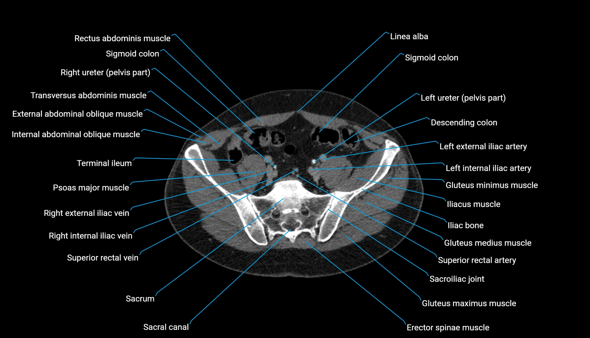 CT urogram axial cross sectional anatomy  labelled radiology image-00187.webp